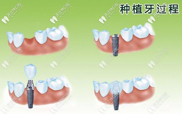種植牙過(guò)程圖