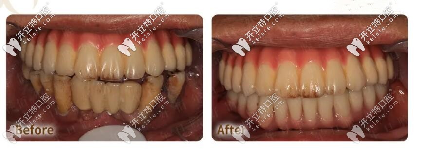 即刻負(fù)重的種植牙