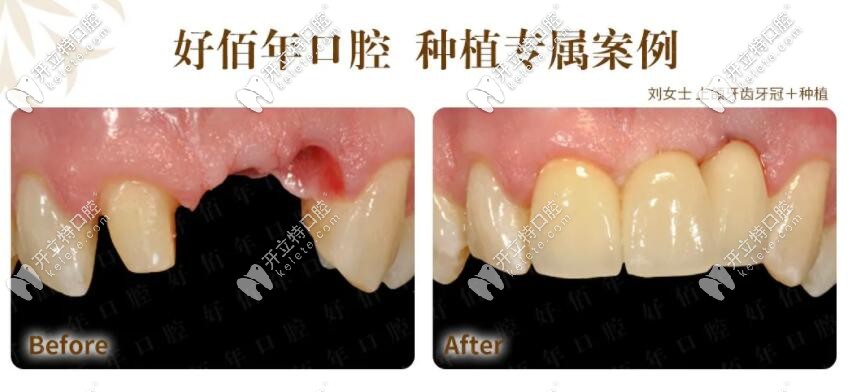 頜牙齒缺失做種植牙案例