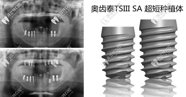 下頜用韓國奧齒泰TSIII SA超短種植體的案例