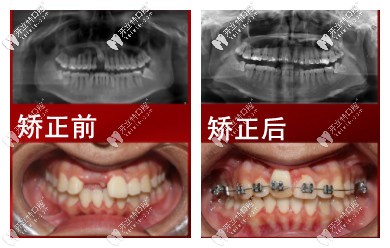 矯正前后對比