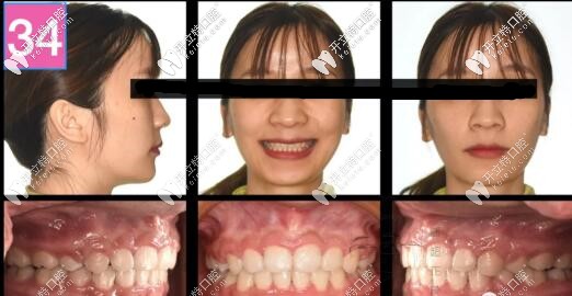 骨性二類齙牙單純正畸側(cè)貌效果圖