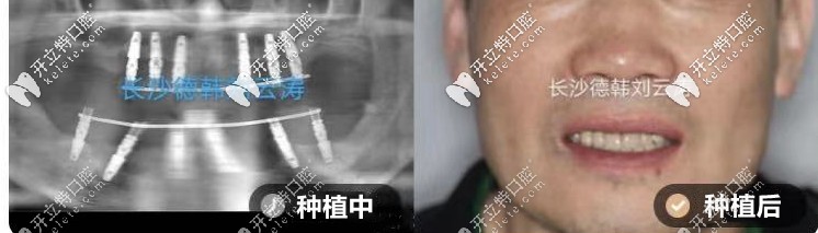 劉云濤：上半口all-on-6種植、下半口all-on-4種植