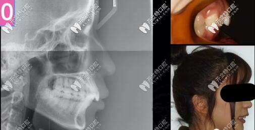 骨性二類凸嘴拔牙內(nèi)收案例