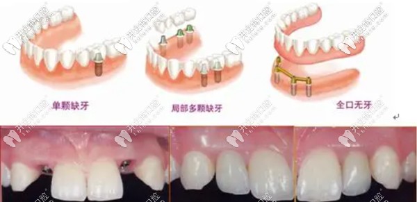 重慶牙博士當(dāng)天種牙、當(dāng)天戴牙當(dāng)天用