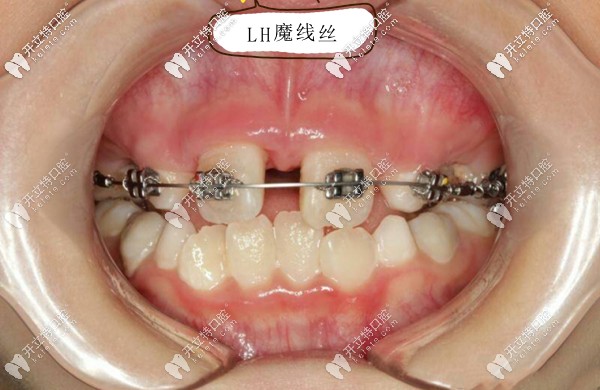 LH魔線絲矯治技術