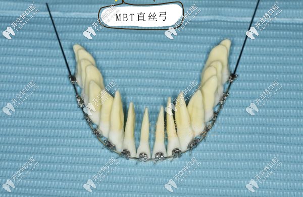 mbt直絲弓正畸技術