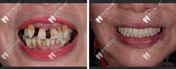 長(zhǎng)沙牙祖口腔周磊種植案例二