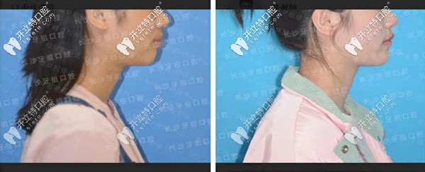 長(zhǎng)沙牙祖口腔沙米矯正案例一
