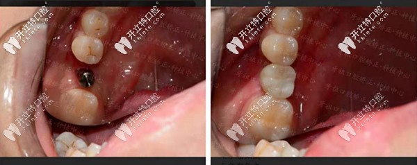 長(zhǎng)沙牙祖口腔周磊種植案例一