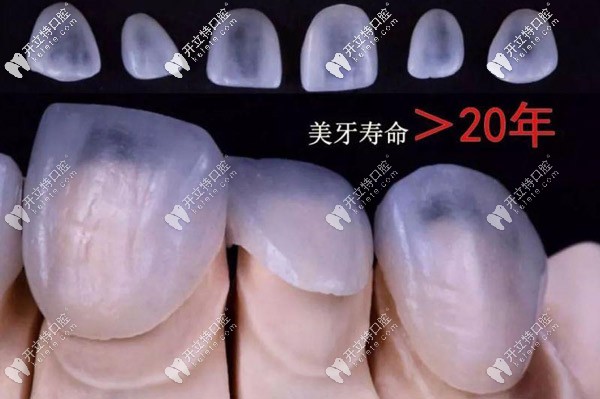 全口16顆超薄瓷貼面的價(jià)格