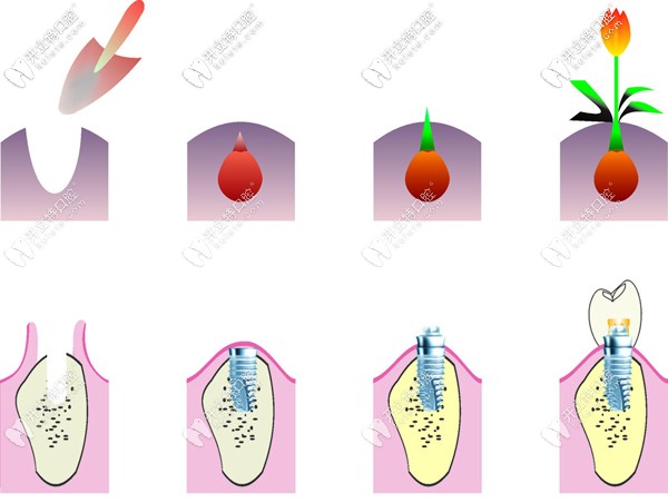 種植牙比擬過程