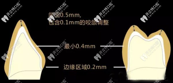 德國(guó)進(jìn)口材料的格萊美全瓷牙價(jià)格