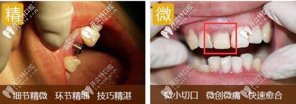 登特口腔德國種植牙醫(yī)生舒斯特的精準微創(chuàng)種植牙案例