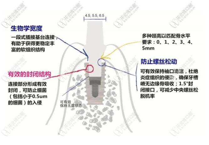 仕諾康植體特點(diǎn)介紹
