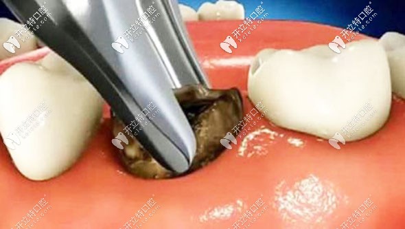 我20歲做種植牙的經(jīng)歷 我20歲做種植牙的經(jīng)歷