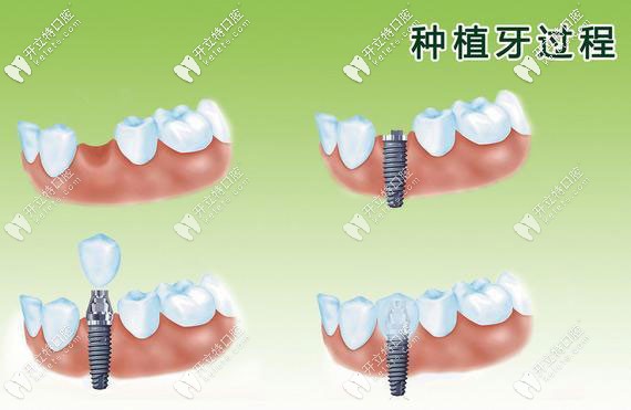 種植牙過程演示圖 種植牙過程演示圖