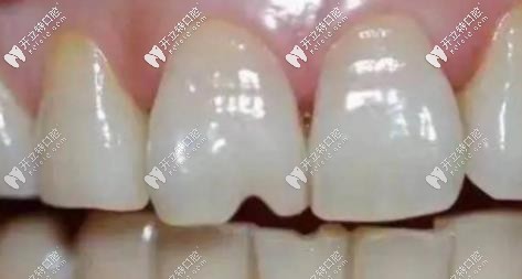 常吃堅果會加速牙齒的磨耗，使牙齒出現(xiàn)裂紋