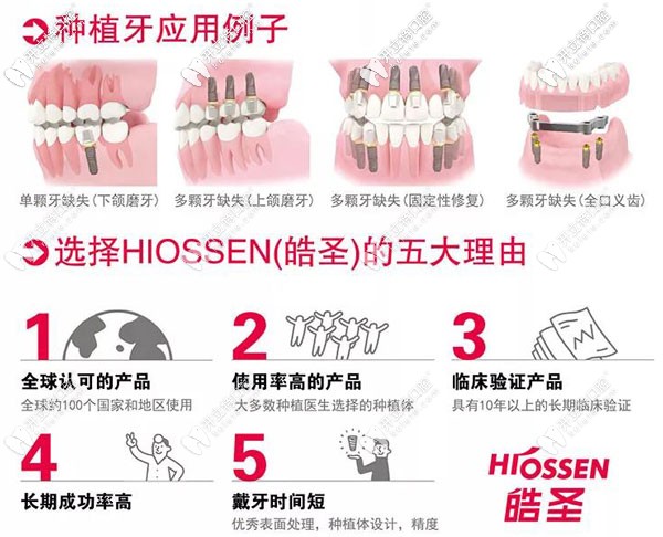 皓圣ETIII SA種植體，支持延期種植又擅于即刻種植