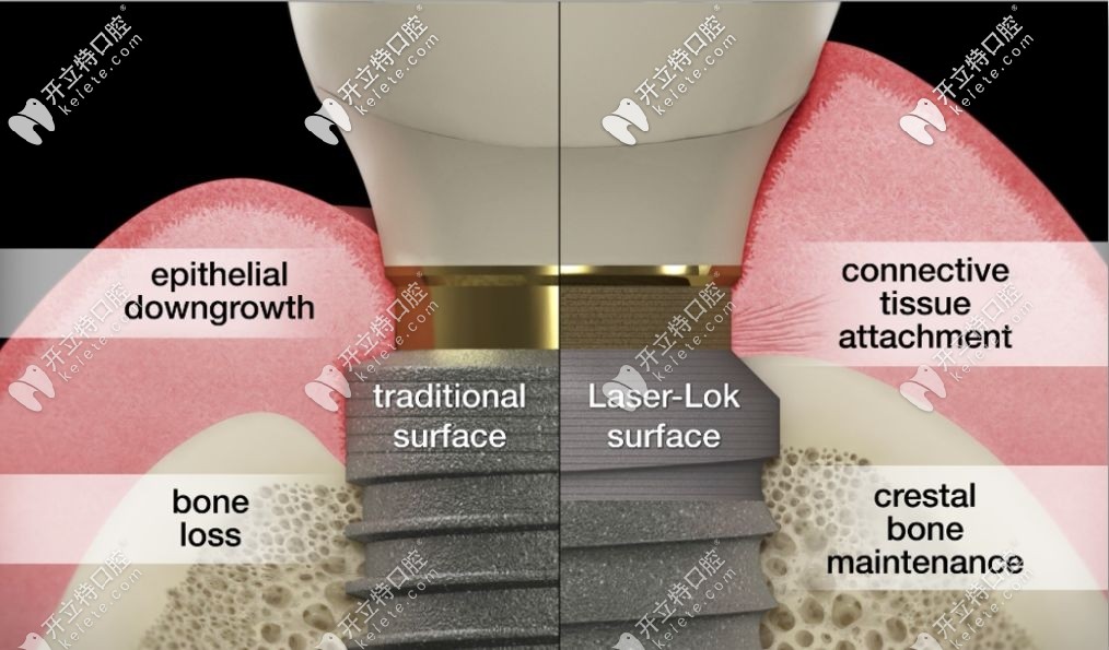 愈合后的牙周組織對比