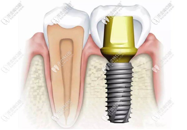 廣州天河區(qū)牙科做種植牙的費用