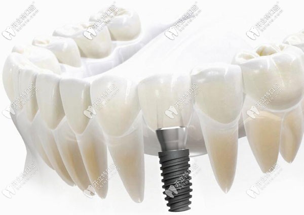 天河區(qū)做歐美種植牙的價格