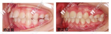 孫丹陽(yáng)醫(yī)生的矯正<span style=