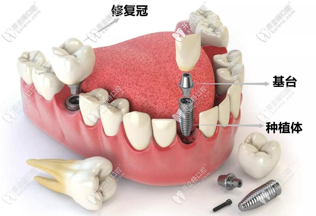 種植牙的結(jié)構(gòu)圖展示