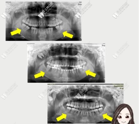智齒前移代替磨牙