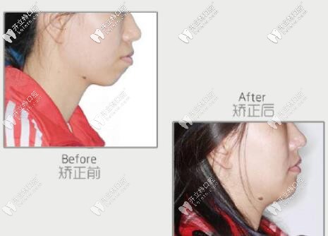 正畸智齒代替7號(hào)牙案例