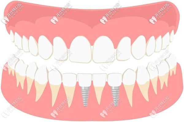 種植牙咀嚼功能恢復百分之多少