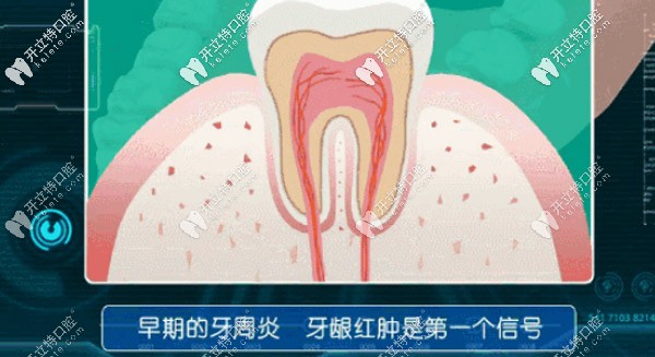 早期牙周炎，牙齦紅腫是個(gè)信號