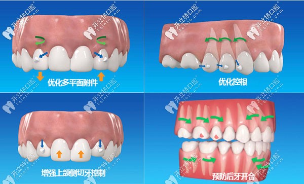 數(shù)字化口腔正畸口掃的效果展示
