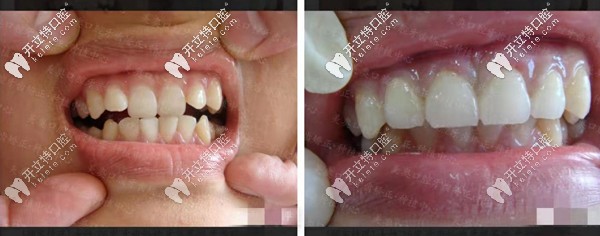 矯正前后對(duì)比圖三