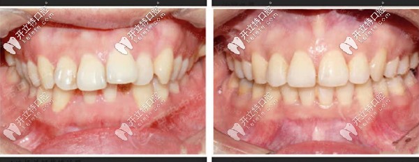 齙牙陶瓷自鎖矯正前后對(duì)比