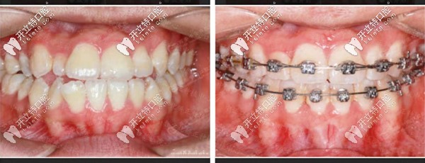 地包天金屬自鎖矯正前后對(duì)比