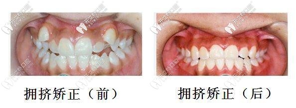 看看我的虎牙長在牙齦上做矯正的效果吧,價格也不貴哦