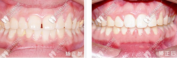 矯正前后對比