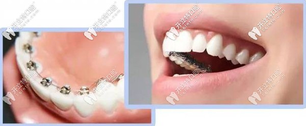 舌側(cè)隱形矯正
