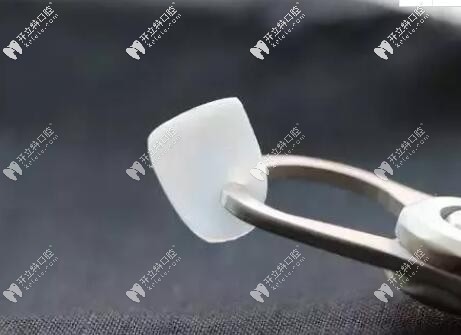 牙齒貼面
