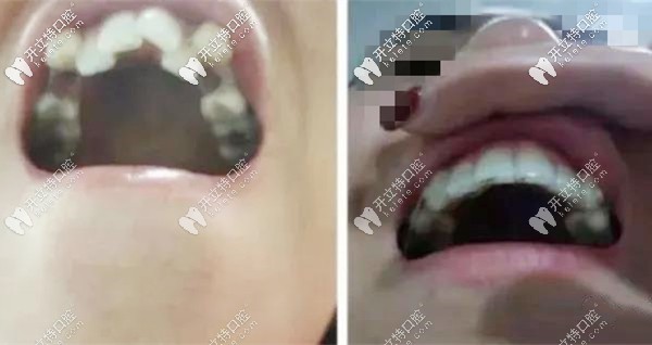 戴隱形牙套1年半的效果圖