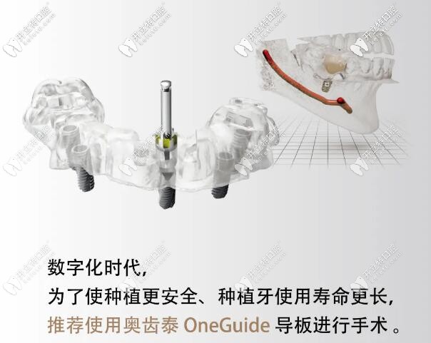 韓國奧齒泰3D數(shù)字化種植牙導(dǎo)板