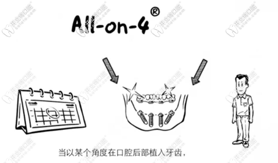 allon4種植牙漫畫圖