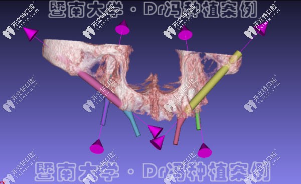 穿顴骨種植技術(shù)的電腦模擬效果