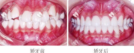 矯正牙齒前后對(duì)比圖