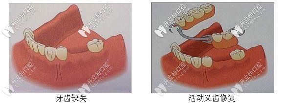活動(dòng)假牙修復(fù)示意圖
