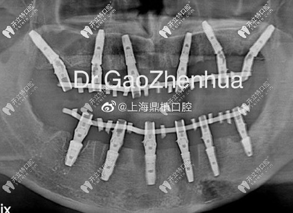 全口即刻負重即刻修復