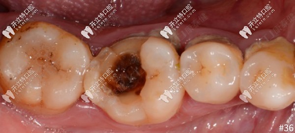 牙齒大面積缺損，用康泰健格萊美瓷嵌體修復(fù)案例分享