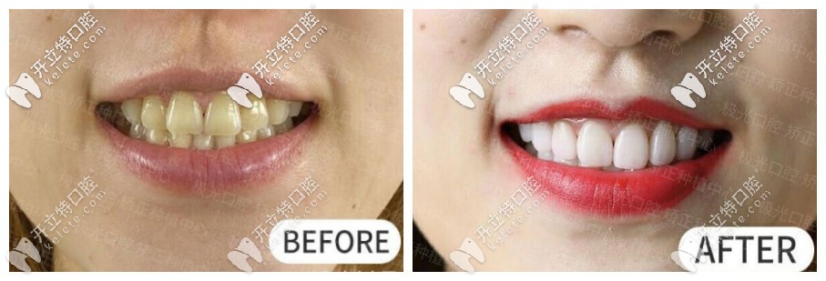 牙齒貼面前后對(duì)比圖