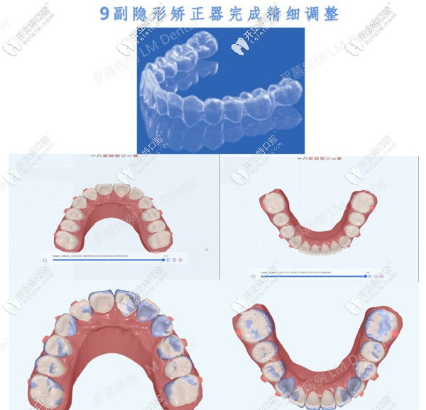 羅慕早期干預(yù)后需要9副透明牙套來完成精細調(diào)整